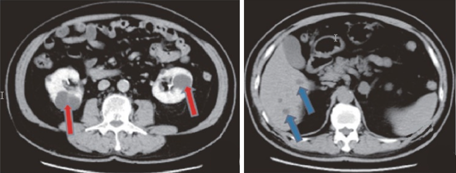 ct 上显示的多囊肾(左)和多囊肝(右)