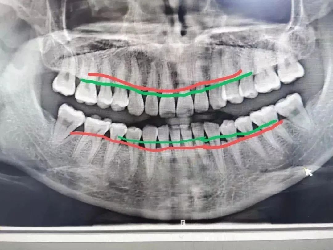 红线是我牙槽骨侵蚀的现状 绿线是健康牙齿该有的状态