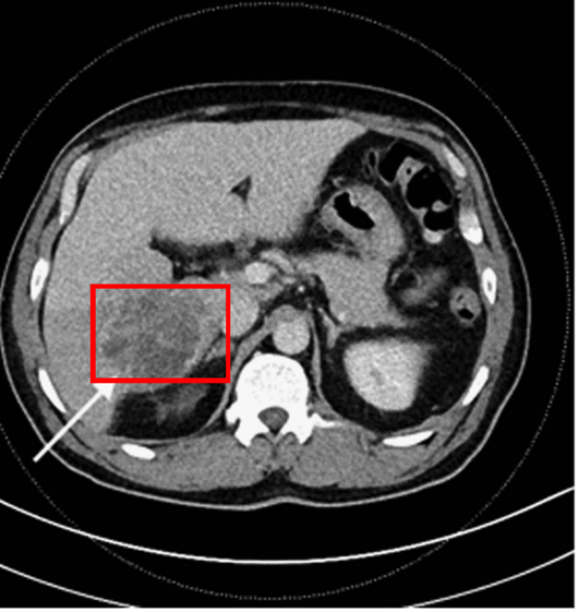 下图中箭头所指的红框区域,则是早期肝脓肿在 ct 检查中的表现——类