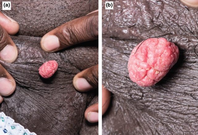 clin exp dermatol上介绍了一例以阴囊部位红色结节为特征的典型病例