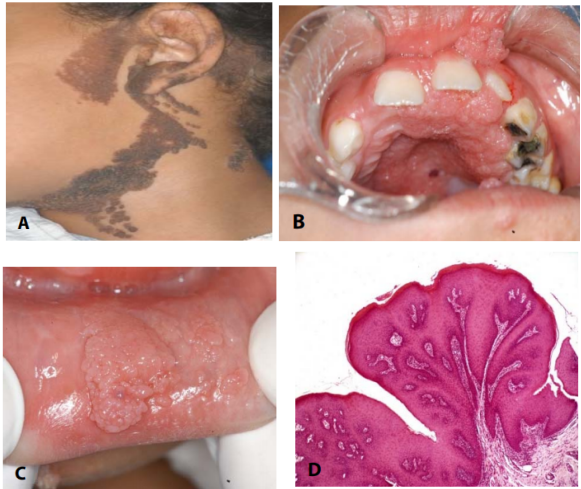 今日病例:线样疣状表皮痣累及口腔