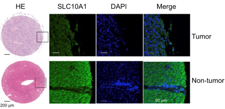 肿瘤或非肿瘤的肝组织中,slc10a1蛋白的多色免疫荧光染色本研究通过