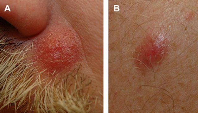 脓疱  有些丘疹性梅毒疹患者的鼻部和前额可出现少量脓疱和结痂.
