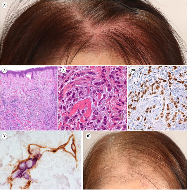 seborrheic dermatitis-like metastatic breast cancer.jpg