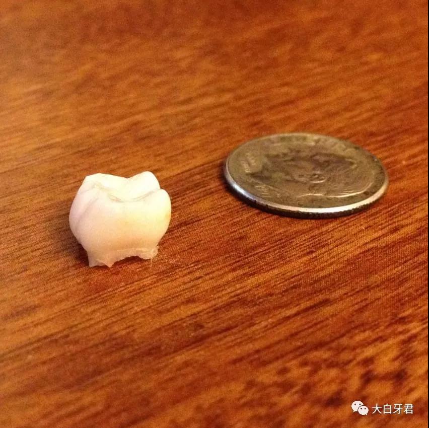 牙根「消失」的乳牙