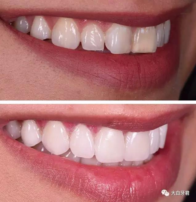 重度的氟斑牙,四环素牙,和其他各种原因造成的牙齿染色或天生牙齿(很