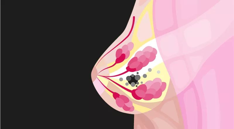 乳腺增生会癌变吗?这些乳房健康知识,每个女性都要了解