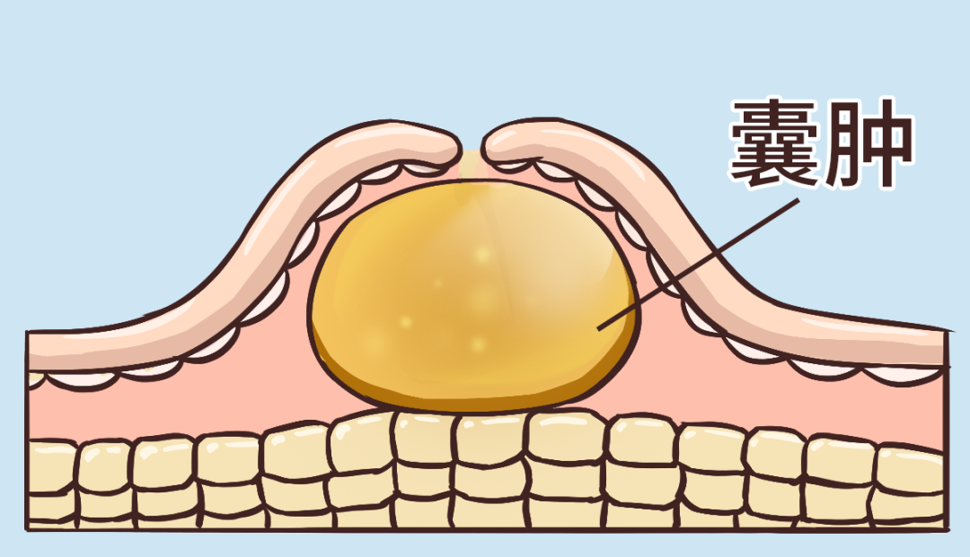 体检查出囊肿会变成癌么要切除么一文给你说清楚