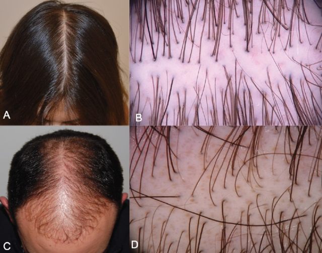 特征:雄激素性脱发(androgenetic alopecia)是最常见的非瘢痕性脱发