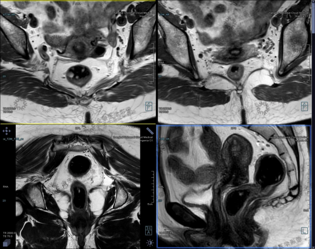 高分辨率mri增强在直肠癌t分期中的临床应用