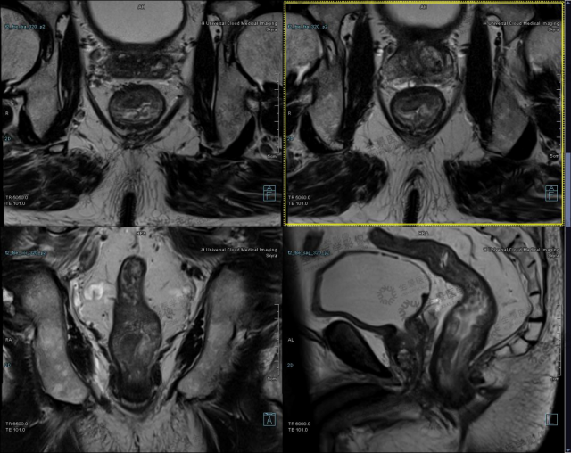 高分辨率 mri 增强在直肠癌 t 分期中的临床应用