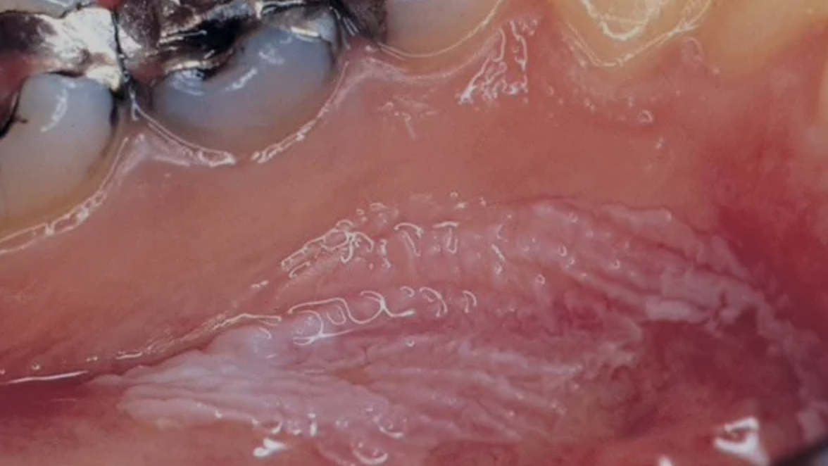 口腔黏膜上的白斑可能成为「癌前病变」.