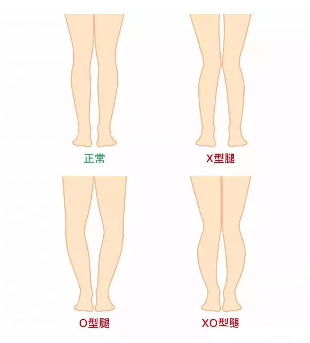 先来看看常见的不好看的腿型有:x 型腿,o 型腿,xo 型腿等