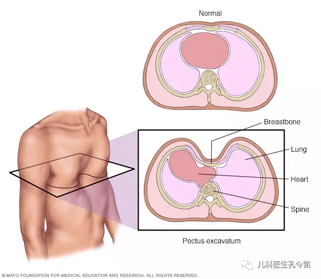 鸡胸漏斗胸,补钙能纠正吗?