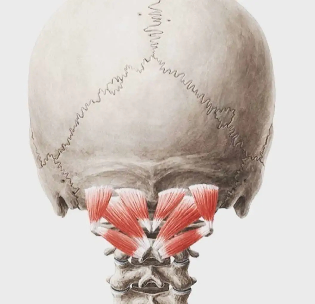 和上颈椎触诊引起,其他症状相关发现包括颈深屈肌无力和位于上斜方肌