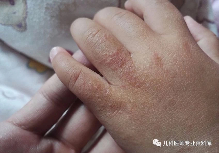 夏秋季,孩子最常见的皮肤病-沙土皮炎