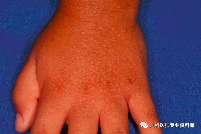 夏秋季,孩子最常见的皮肤病-沙土皮炎