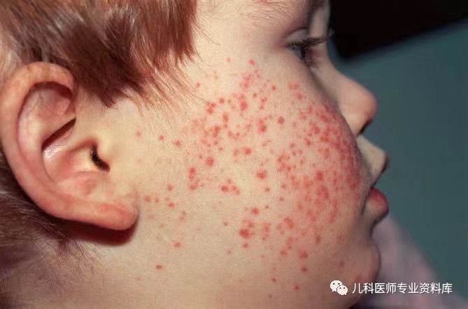 儿童丘疹性肢端皮炎(papular acrodermatitis)是一种呈现为肢端分布