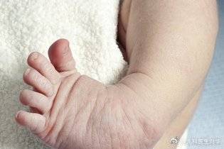 新生儿马蹄内翻足