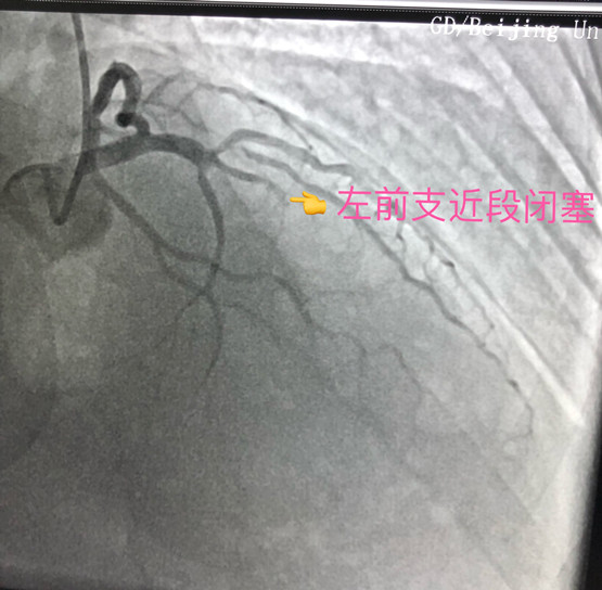 介入手术前,张先生被堵塞的心血管