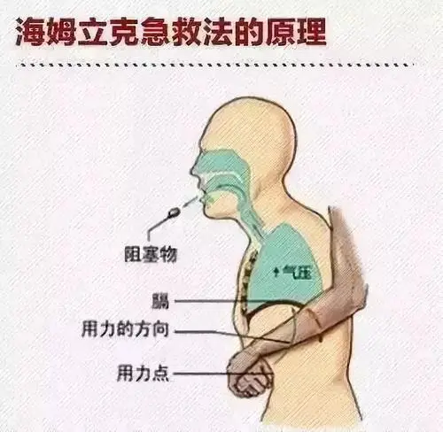 别再张冠李戴了不是所有的窒息急救都叫海姆立克