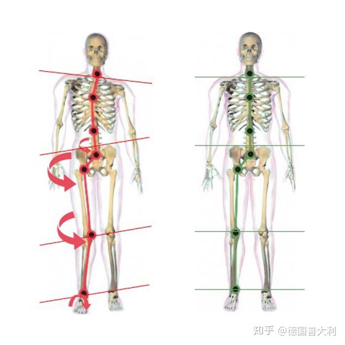 当为足型为扁平足时,膝关节会外翻,股骨内旋会做出代偿使下肢在站立位