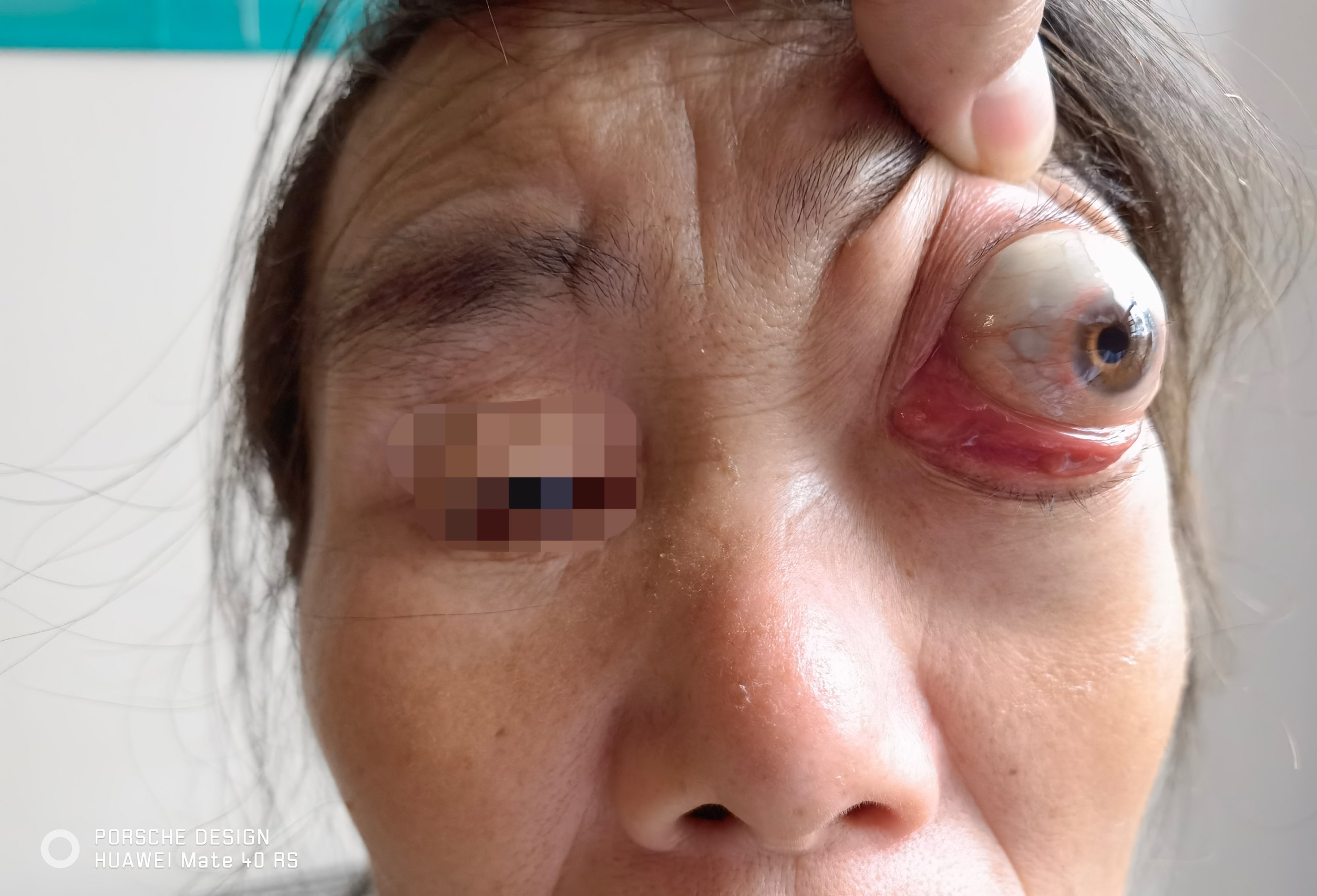 眼内长「鸡蛋」般巨大肿瘤,女子眼球被挤脱臼