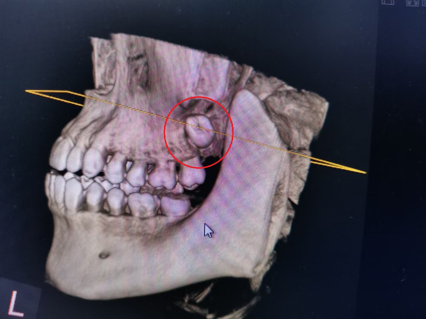 「大多数患者的智齿长在上,下牙槽窝内,但她俩的智齿却远离牙槽窝