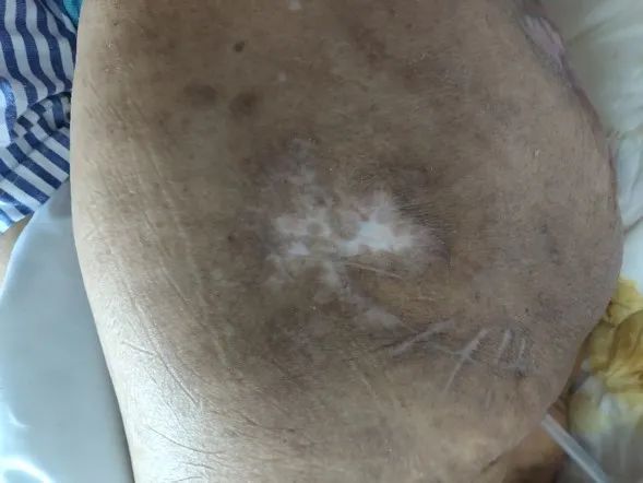 难愈性溃疡压疮通过微创治疗愈合骶尾部肿瘤术前术后在糖尿病足,压疮