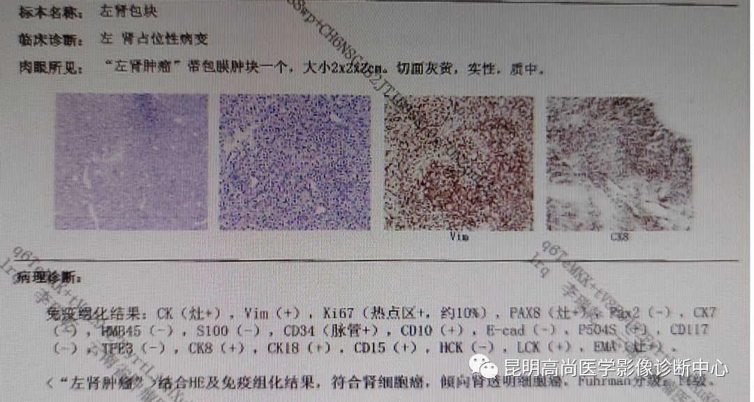 首页>行业资讯【高尚病例】63岁女性日常无症状,体检发现左肾癌>病理