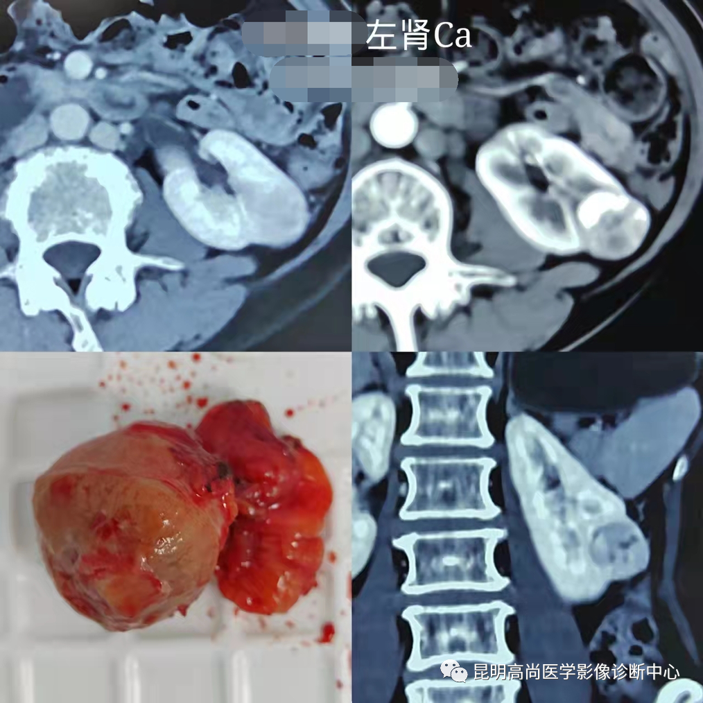 体检发现左肾癌>病理诊断:左肾透明细胞癌病理分期:tin0m0术后肿块