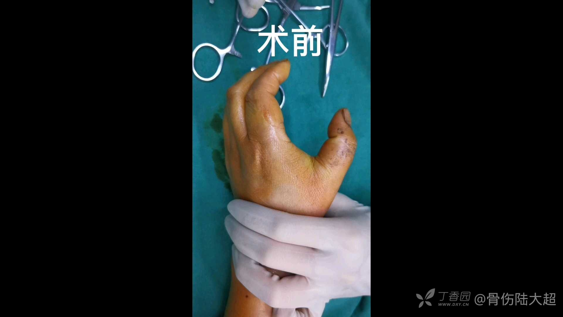 拇指弹响腱鞘炎手术分享