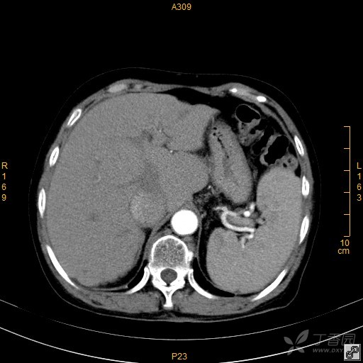 大家讨论下下腔静脉到底是怎么了,增强好奇怪. [病例帖]