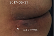 水疱护理，刺破还是保留？这回知道怎么处理了