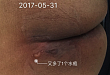 水疱护理，刺破还是保留？这回知道怎么处理了