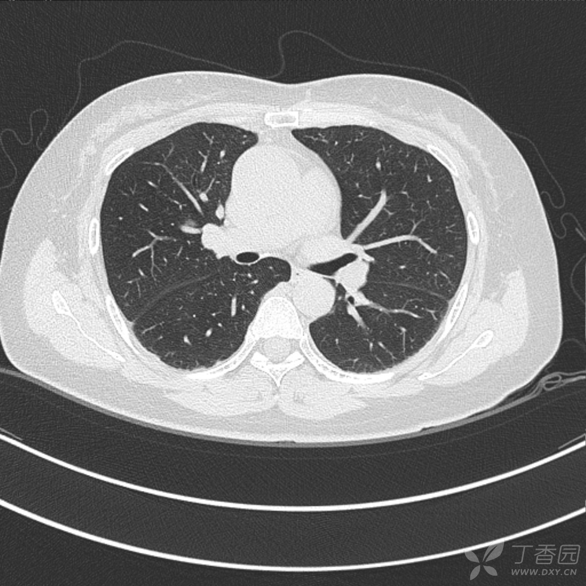 典型肺硬化性血管瘤?类癌?