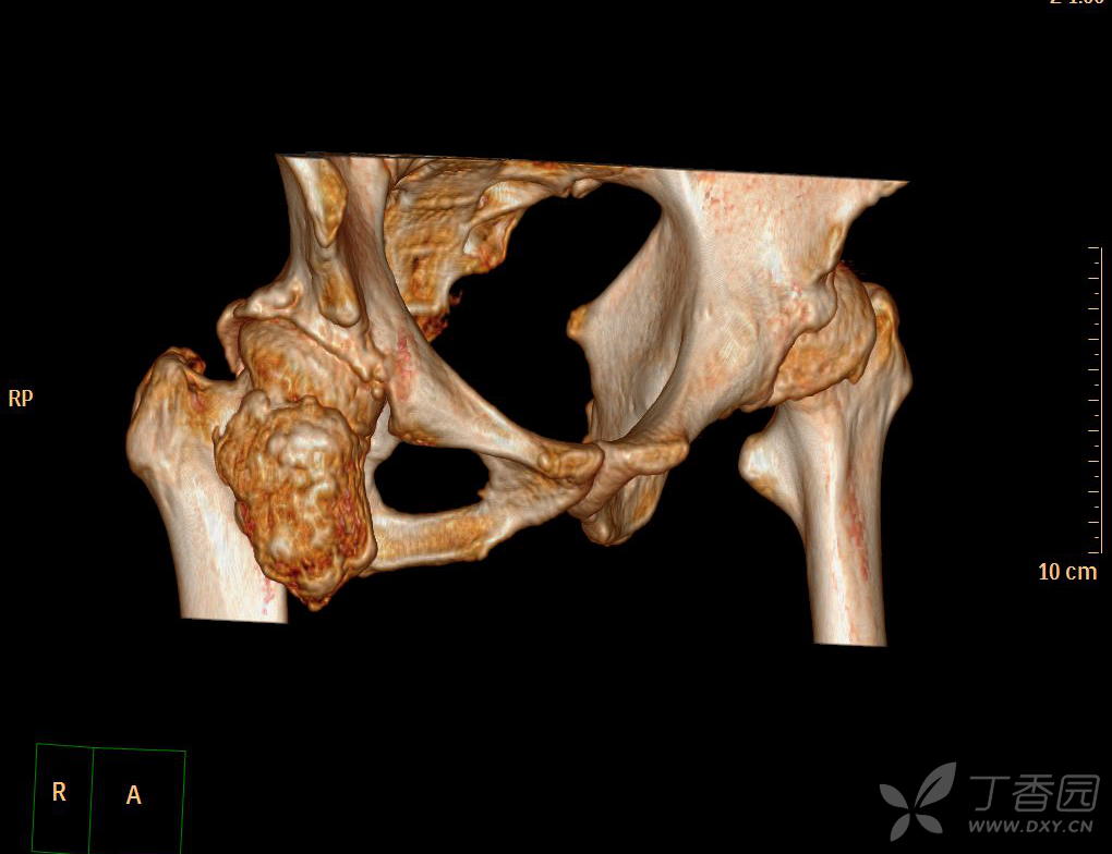 骨盆骨软骨瘤图片