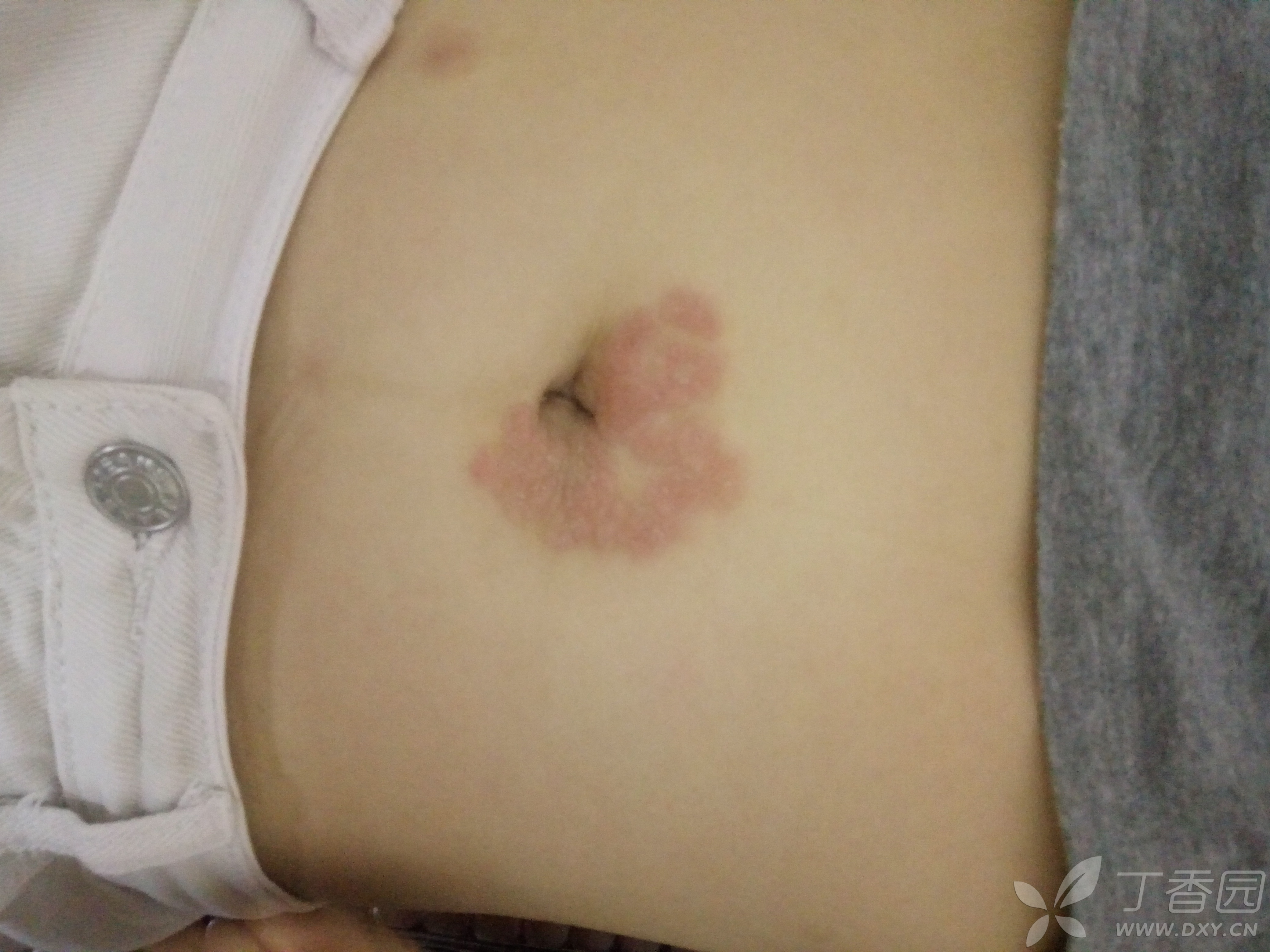 肚脐周围片状红斑,是什么皮肤病?过敏性皮炎?