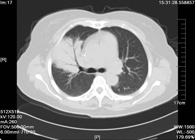 肺原发性淋巴瘤 形似肺炎的原发性肺淋巴瘤 1 例