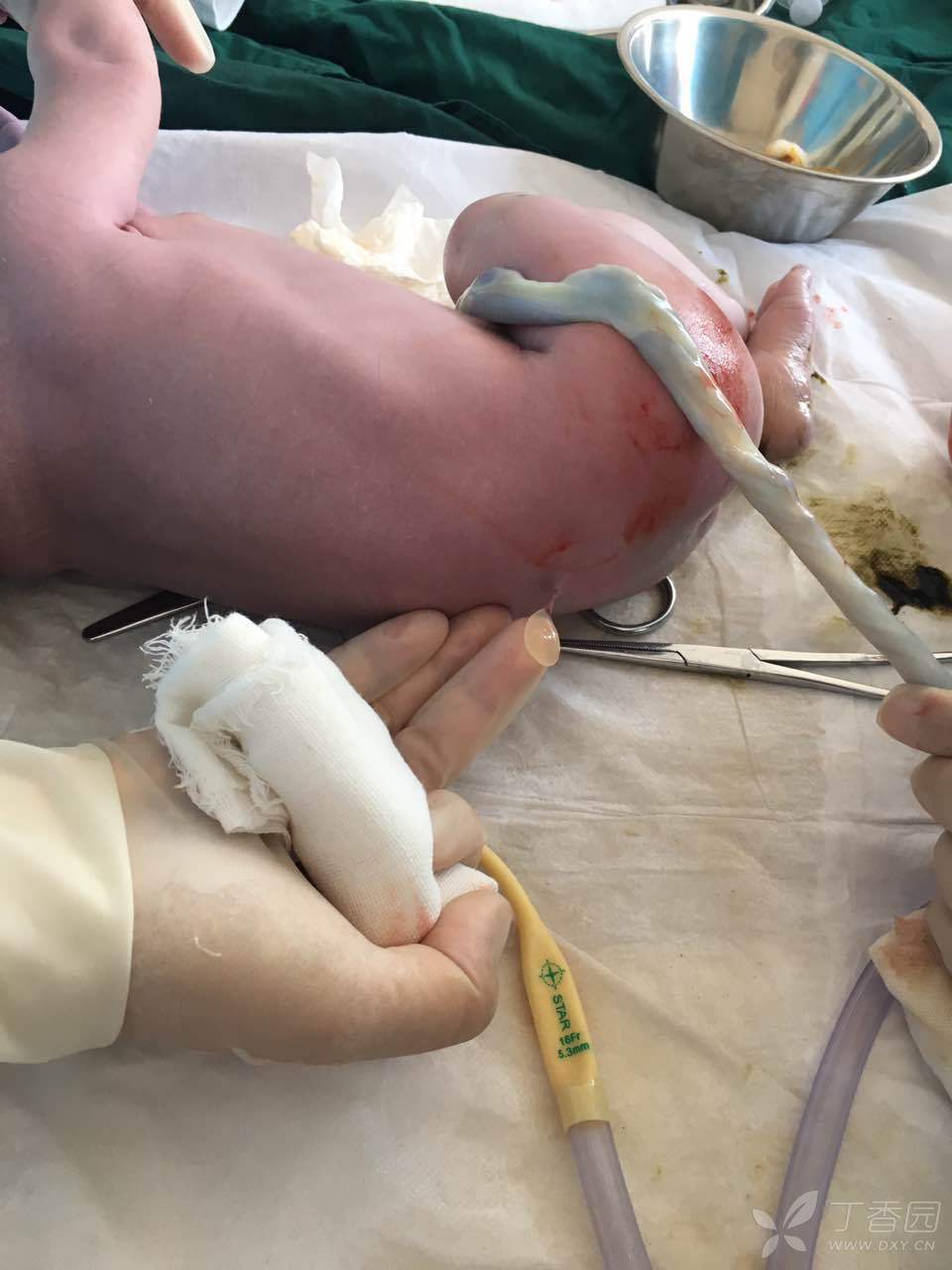 隐性脊柱裂吗? - 超声医学讨论版 -丁香园论坛