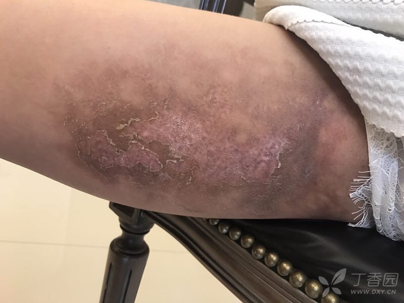 大腿吸脂术后表皮脱落 皮肤与性传播疾病讨论版 丁香园论坛