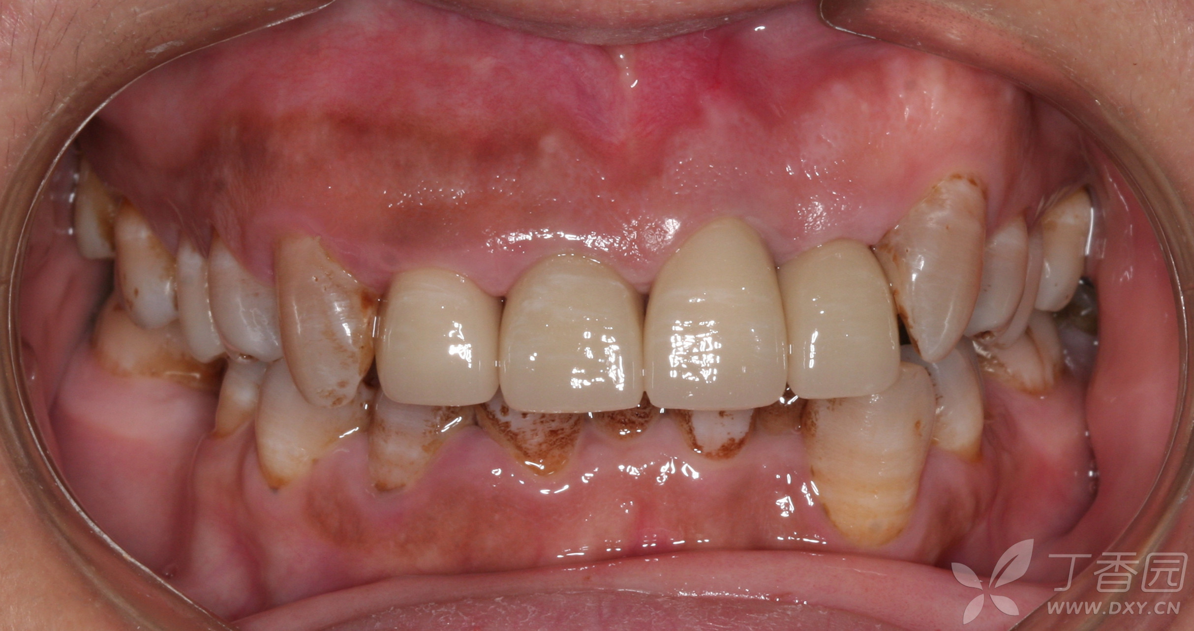 上前牙龈缘曲线严重失调患者的冠修复一例 [病例帖]