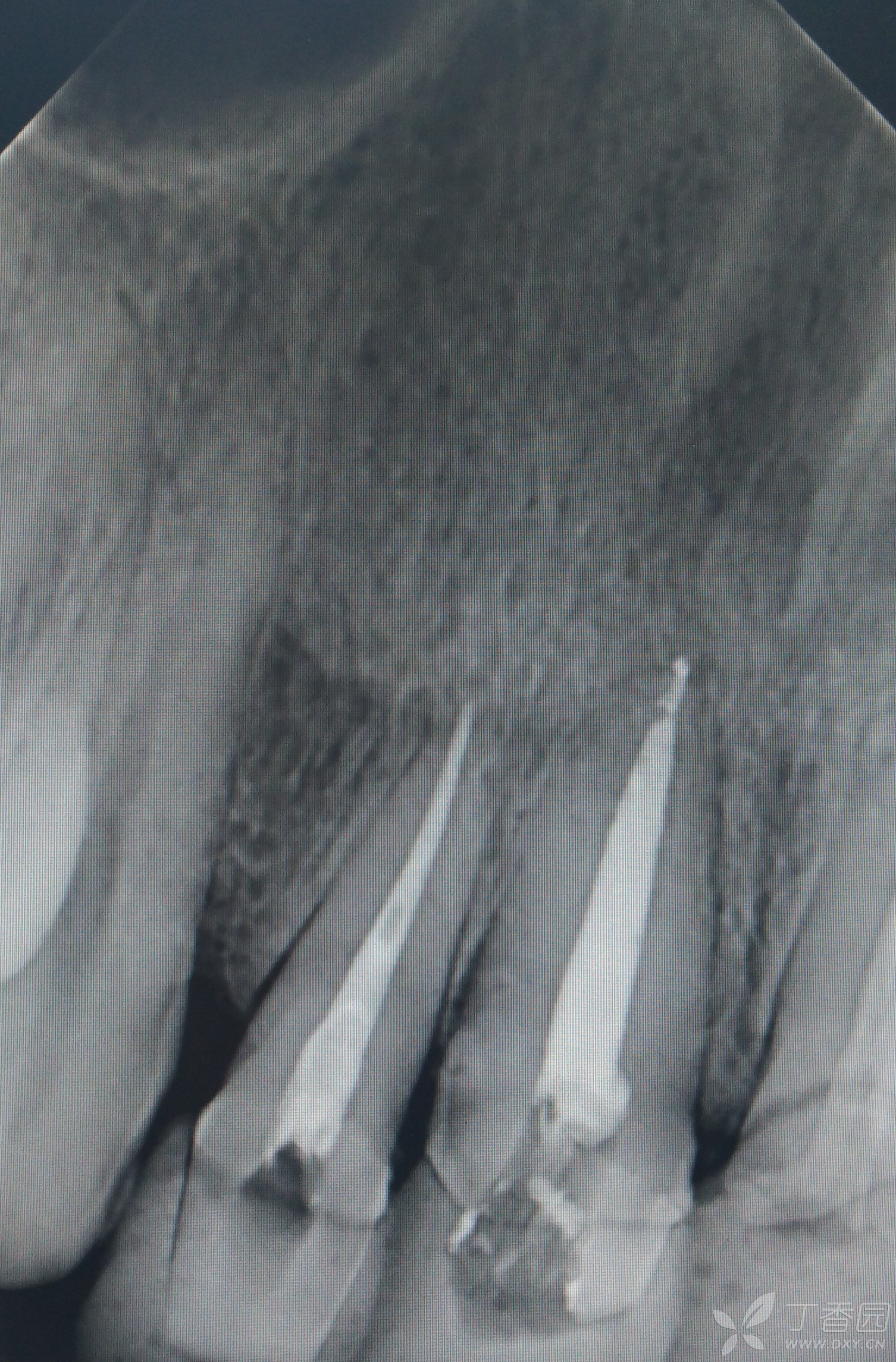 上前牙龈缘曲线严重失调患者的冠修复一例 [病例帖]