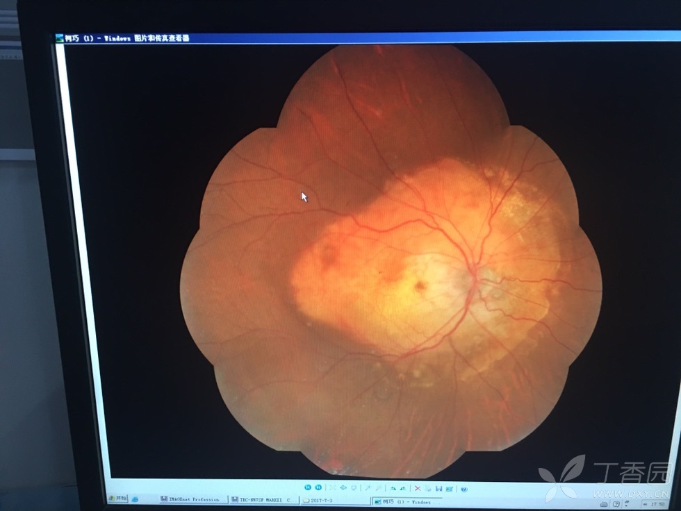 分享一个双眼脉络膜骨瘤的病例 [病例帖]