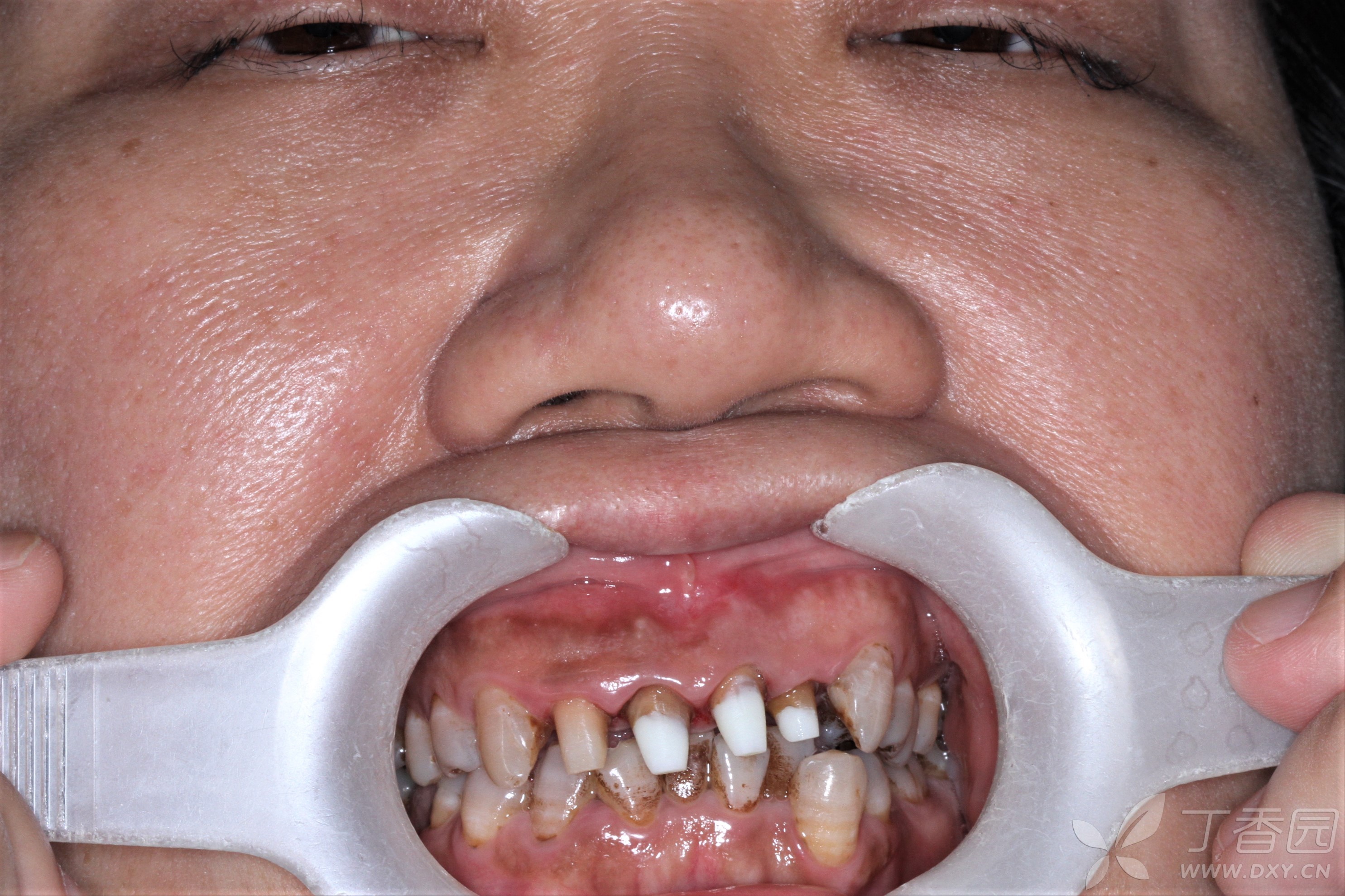 上前牙龈缘曲线严重失调患者的冠修复一例 [病例帖]