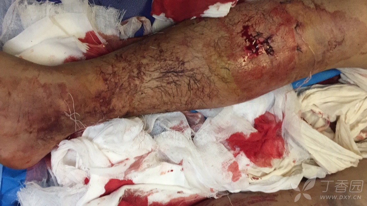 急诊入院,双侧胫腓骨粉碎性骨折,左小腿骨筋膜室综合征,如何处理?