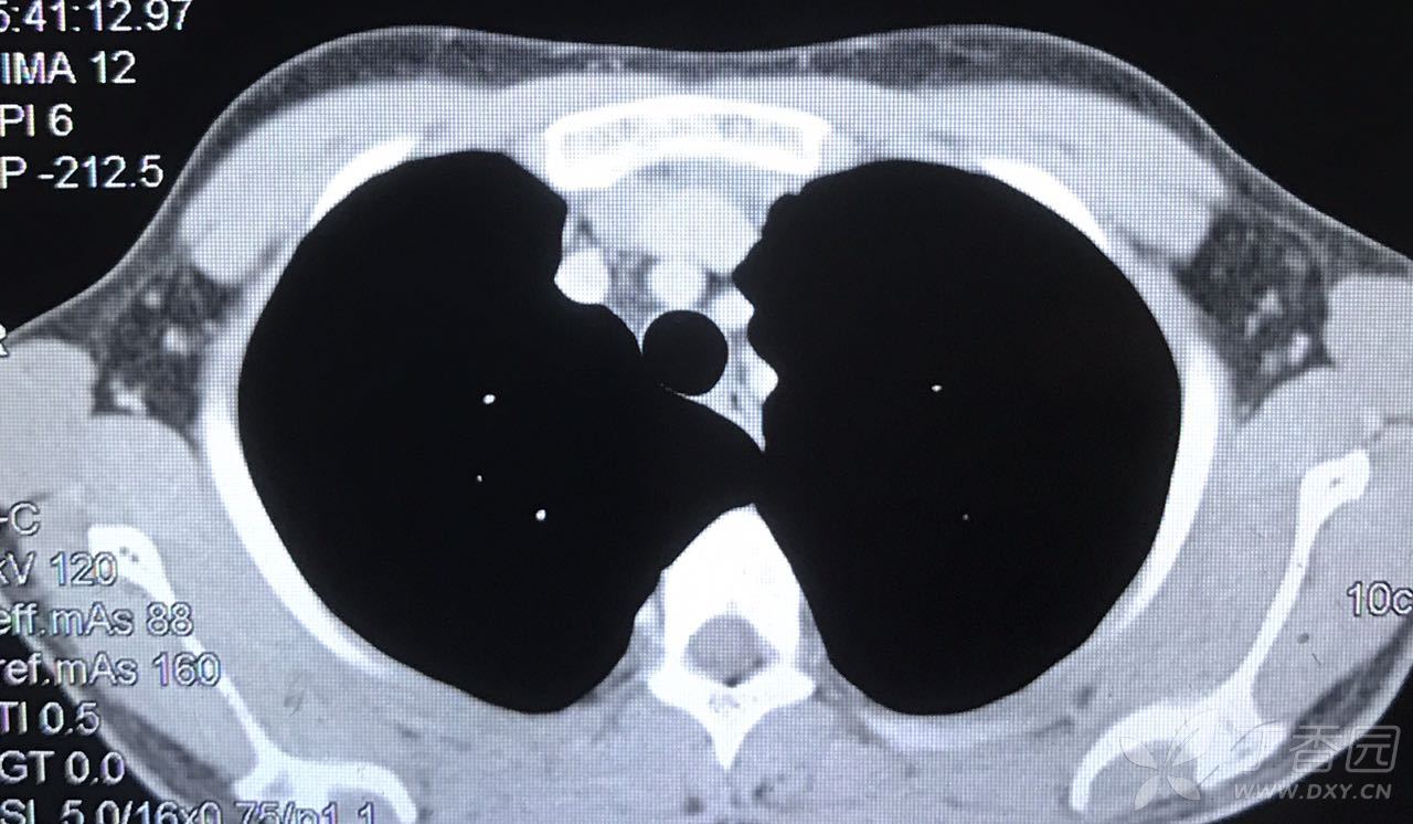 【读片】胸部ct,青年男性,胸腺区密度增高,考虑是什么各位老师麻烦
