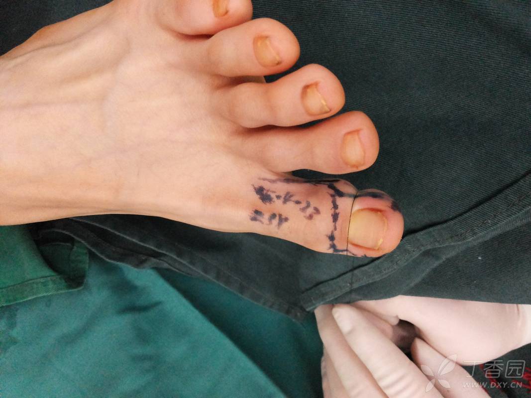 【讨论】保留五个足趾的拇指全型再造 - 修复重建和烧伤整形 -丁香园