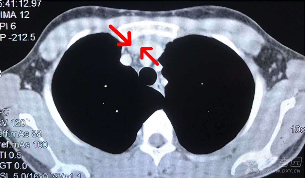 胸腺增生ct表现图片图片