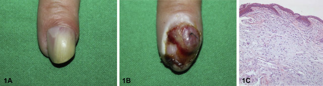 Subungual tumor on the left index finger with light yellowish discoloration.jpg